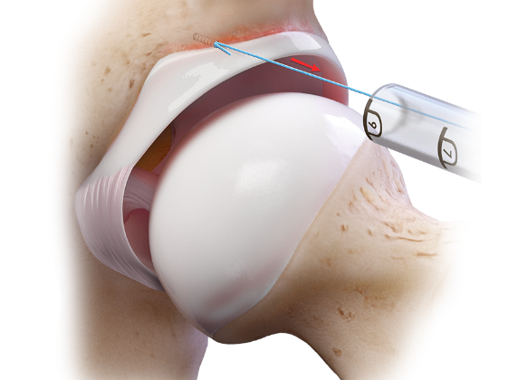 Arthrex - Obturator, Cannulated, for 2.9 mm Hip PushLock